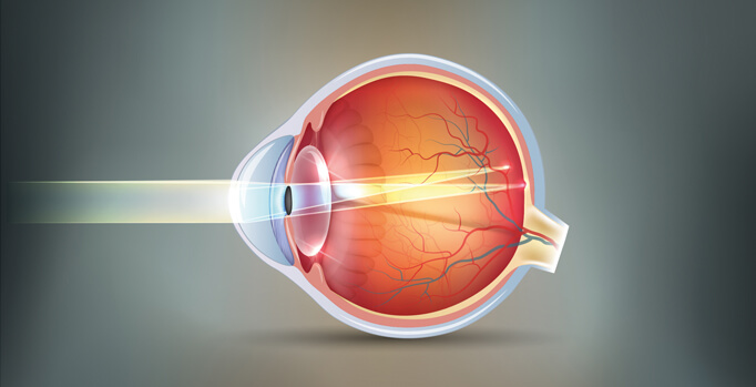 astigmatism eyeball